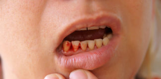 Let’s-Know-Some-Reasons-for-Gums-Bleeding-on-successtuff