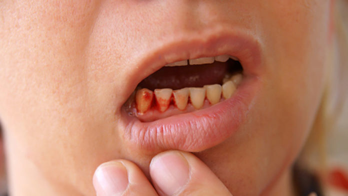 Let’s-Know-Some-Reasons-for-Gums-Bleeding-on-successtuff